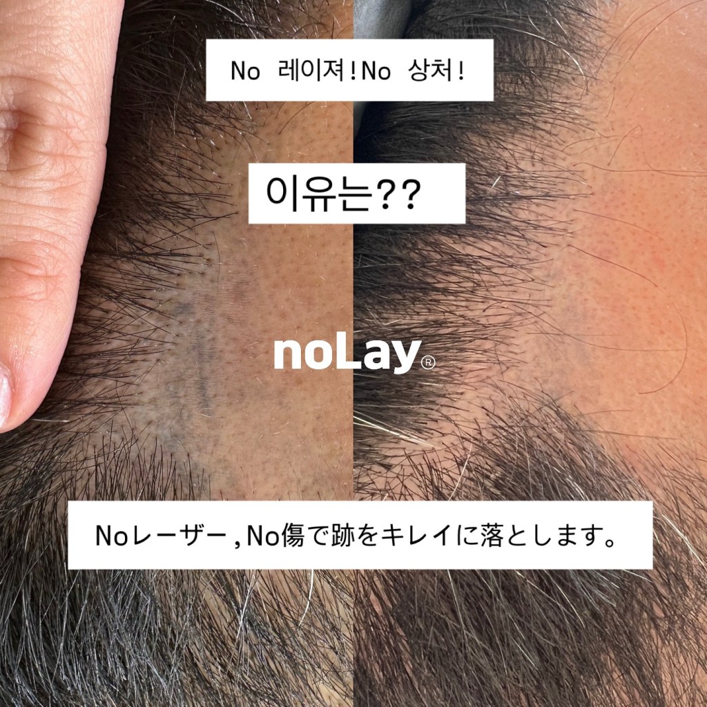 No レーザー、No 傷で跡を綺麗に落とします👍